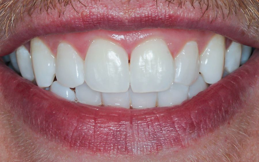 teeth whitening - case 3 - 3Dental